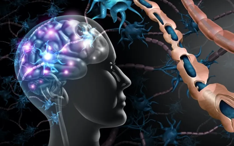 Ilustración del impacto de la esclerosis múltiple en el cerebro. A la izquierda, un cerebro con zonas blancas que denotan daños por EM. Arriba a la derecha, primer plano de la mielina normal y, abajo, de la mielina dañada. (wildpixel vía iStock by Getty Images)